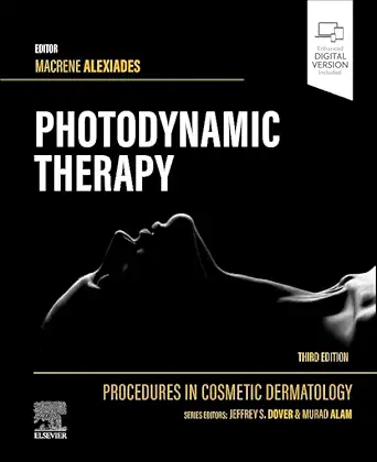 Procedures in Cosmetic Dermatology Series: Photodynamic Therapy