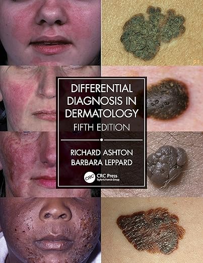 Differential Diagnosis and Treatment in Dermatology