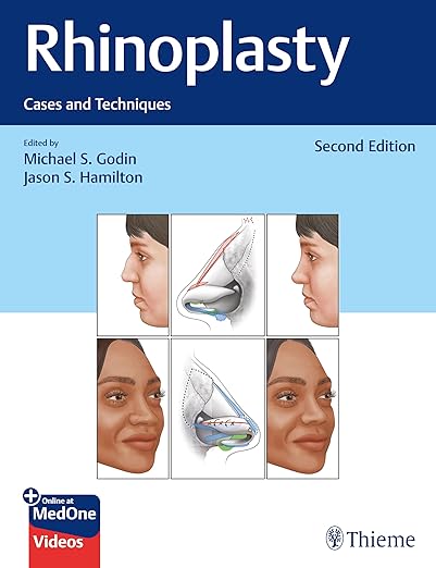 Rhinoplasty - Cases and Techniques