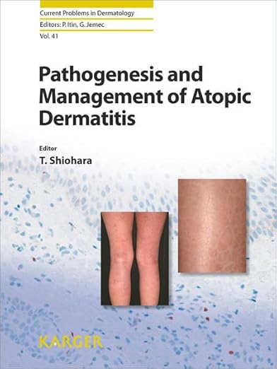 Pathomechanisms, diagnosis, and management of atopic dermatitis