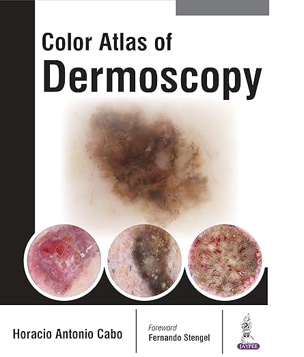 Colour Atlas of Dermoscopy