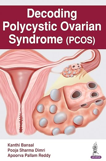 Decoding Polycystic Ovarian Syndrome